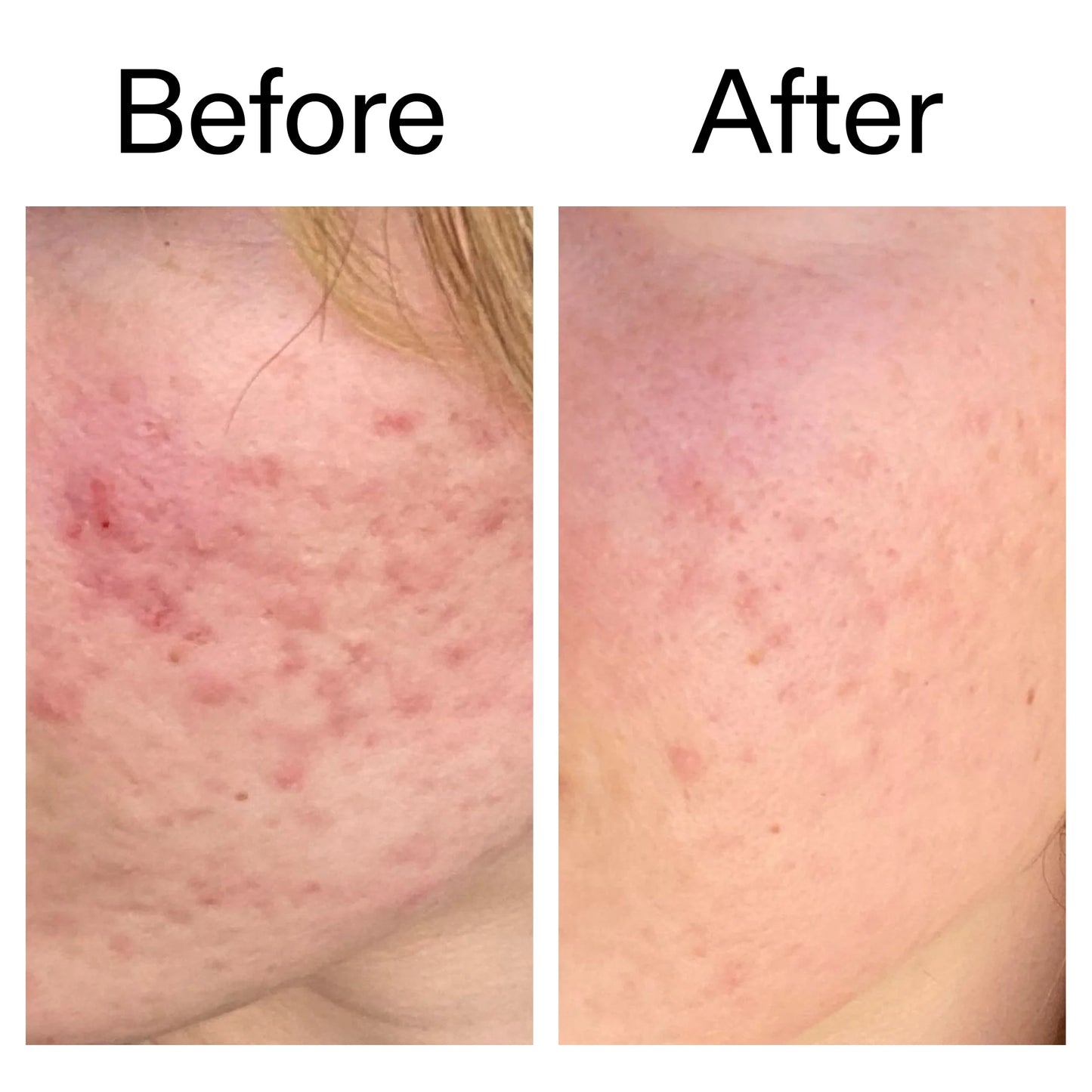 The Inkey List 10% Azelaic Acid Serum for Redness Relief - 30ml