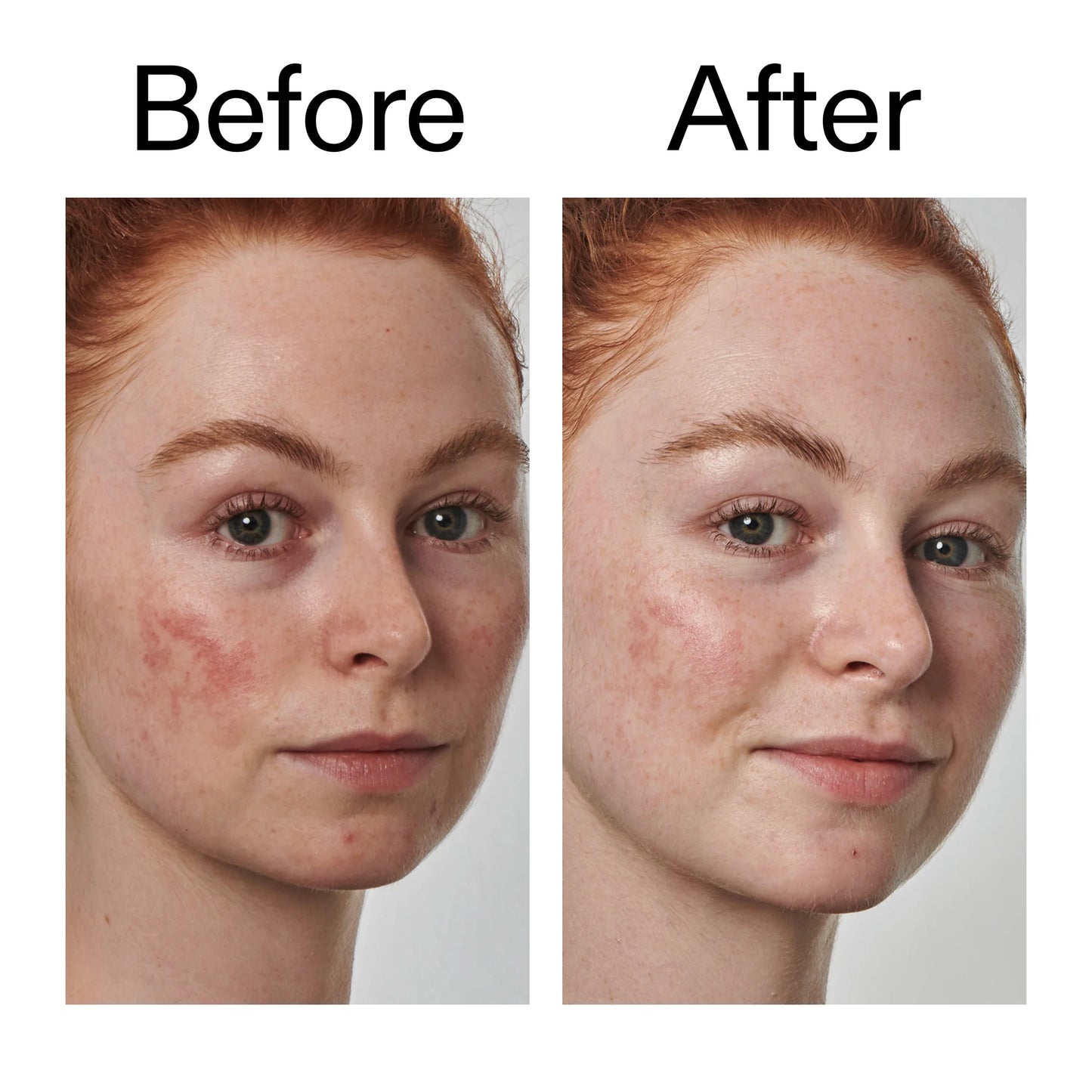 The Inkey List 10% Azelaic Acid Serum for Redness Relief - 30ml
