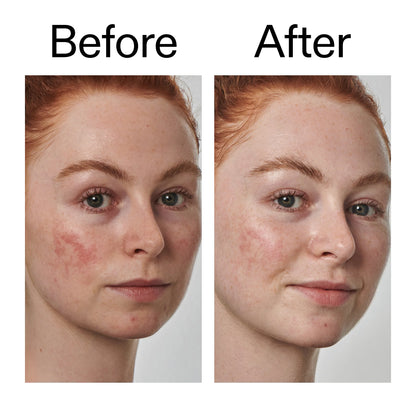 The Inkey List 10% Azelaic Acid Serum for Redness Relief - 30ml
