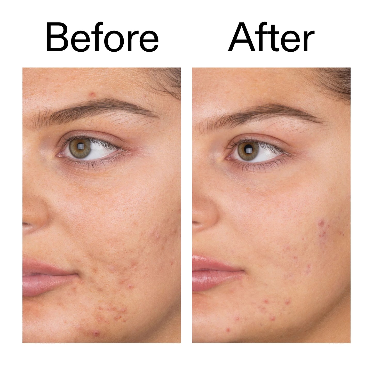 The Inkey List Salicylic Acid Cleanser - 150ml